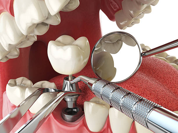 Best Emergency Dentist for Knocked-Out Tooth in Druid Hills, GA
